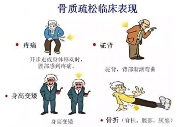 你知道骨質(zhì)疏松癥對你的生活有哪些影響嗎?